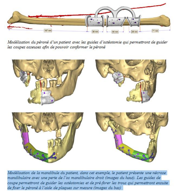 Modélisation d'une mâchoire grâce à la 3D Modélisation d'une mâchoire grâce à la 3D