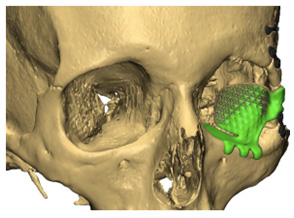 prothèse 3D en titane pour la chirurgie maxillo-faciale