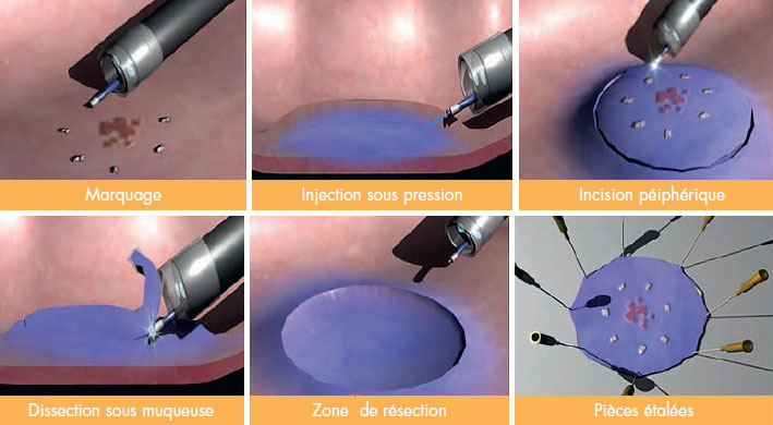 Dissection sous-muqueuse : une expertise internationale aux HCL