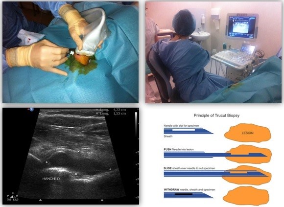Déroulement d'une biopsie synoviale échoguidée