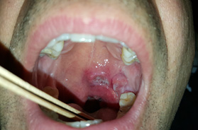 Cancers de la bouche, de la langue, des gencives, du palais et des amygdales