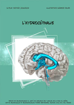 Vignette BD hydrocéphalie