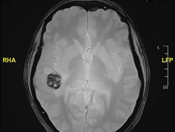 Cavernome cérébral, aussi appelé angiome caverneux - HCL