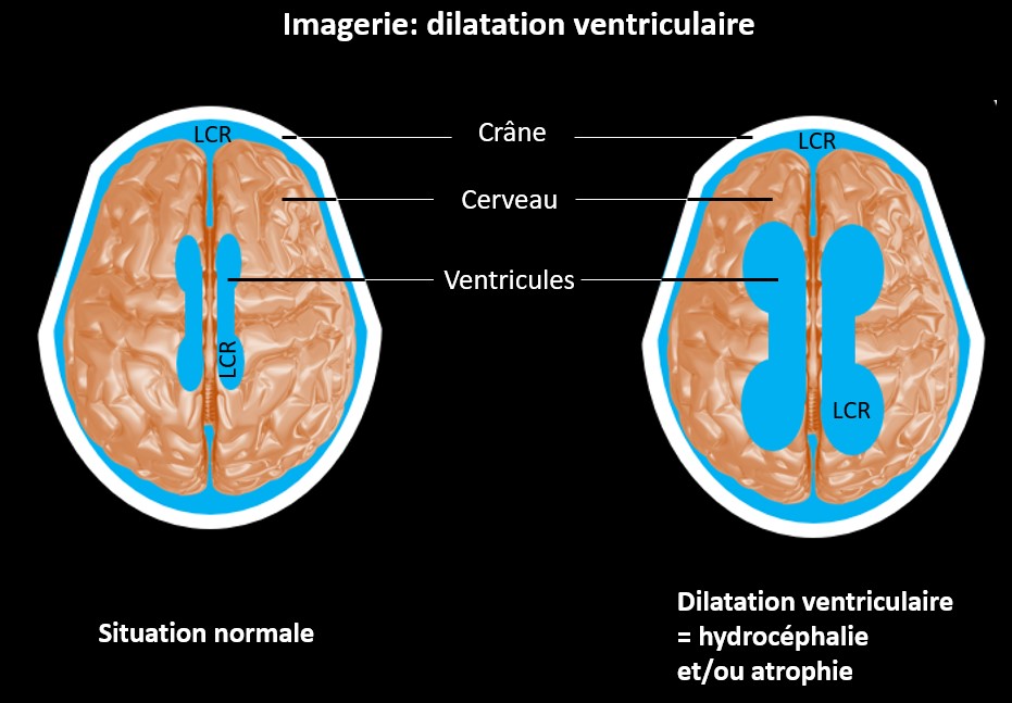 Imagerie : dilatation ventriculaire