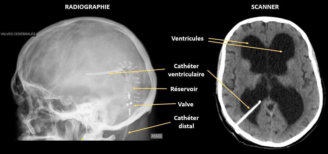 Imagerie : dilatation ventriculaire