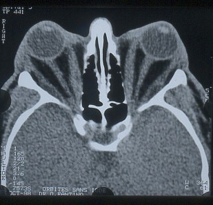 Scanner d’un patient présentant une ophtalmopathie basedowienne