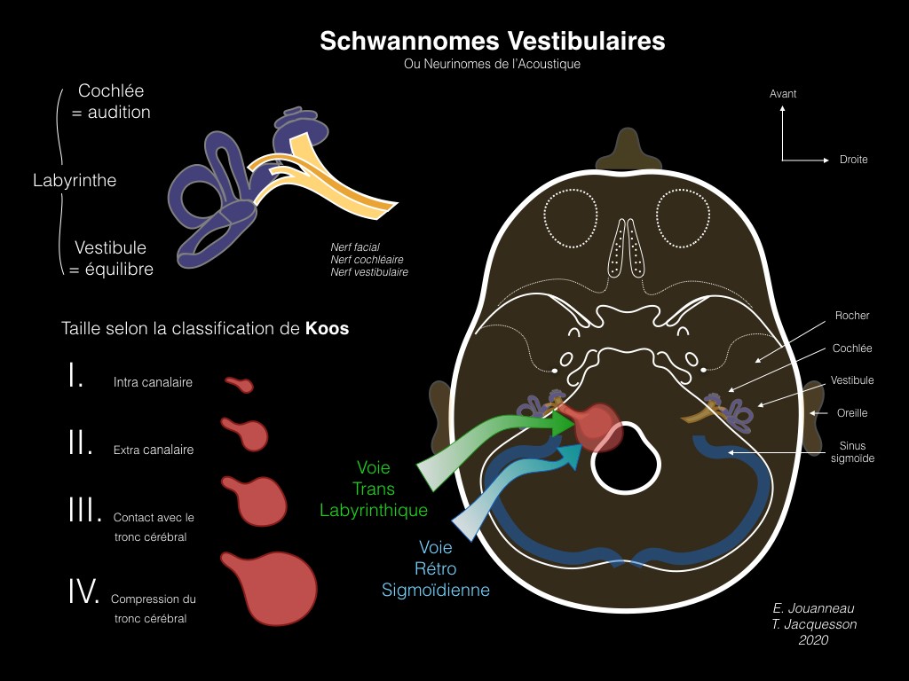 schwannome vestibulaire