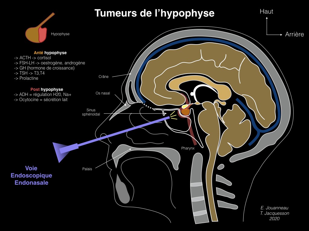 Adénome hypophysaire (tumeur neuroendocrine hypophysaire) | Fiche ...