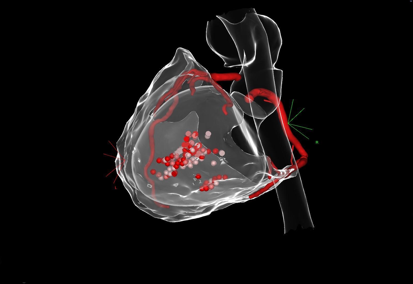 Ablation de flutter cicatriciel sur cardiopathie congénitale complexe de type Fontan