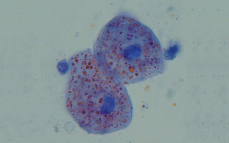 Cellules amniotiques retrouvées dans un LBA (liquide de lavage broncho-alvéolaire) d’une patiente ayant présenté une embolie amniotique clinique.
