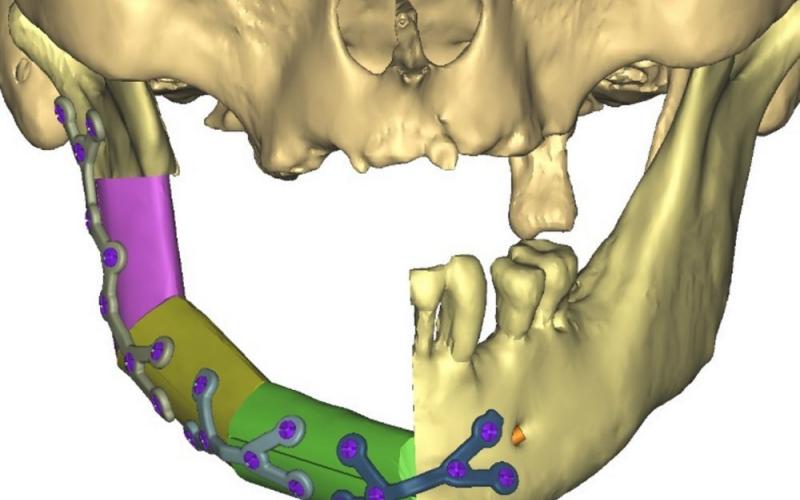 Une nouvelle technique mise au point à Lyon facilite la chirurgie reconstuctrice de la mâchoire