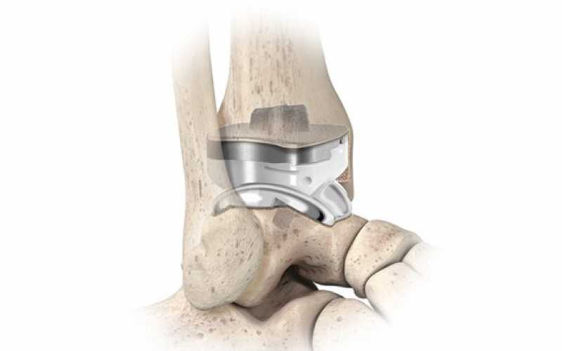 1re pose de prothèse totale de cheville Quantum™