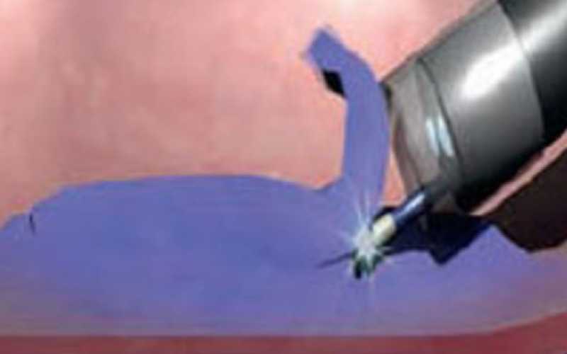 Dissection sous-muqueuse : une expertise internationale