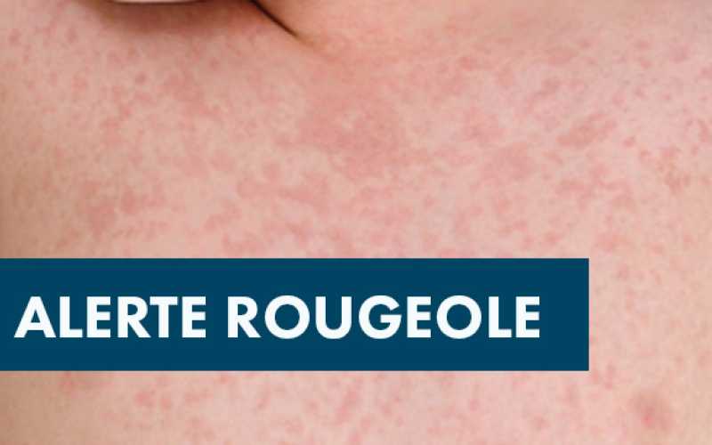 Boutons et bandeau "Alerte rougeole"