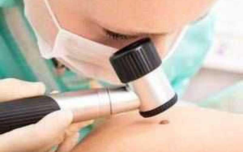 Grain de beauté ou mélanome ?