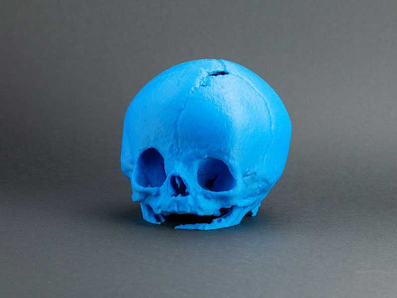 Modèle de craniosténose (malformation crânienne pédiatrique) à visée d’éducation thérapeutique auprès des parents.