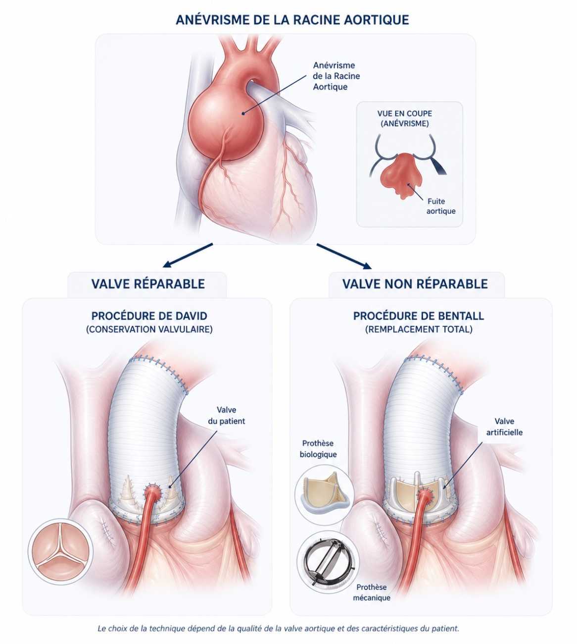 Schéma explicatif des 2 possibilités lors d'un anévrisme de la racine aortique : valve réparable ou valve non réparable