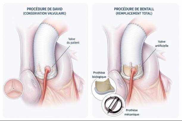 Schéma d'intervention chirurgicale : à gauche la chirurgie de David et à droite la chirurgie de Bentall