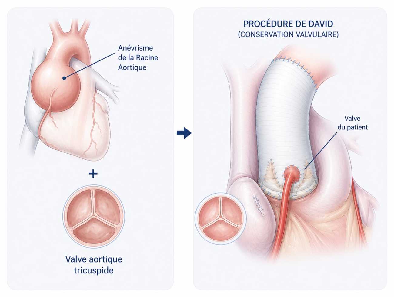 Procédure de David sous forme schéma
