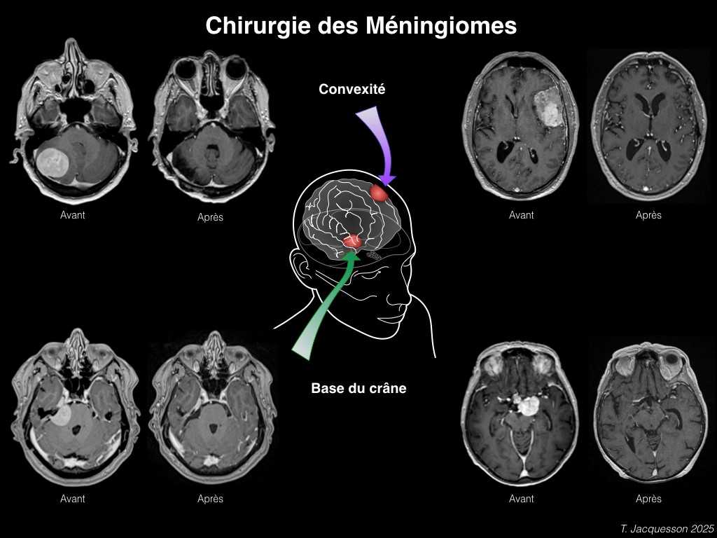 Chirurgie des méningiomes