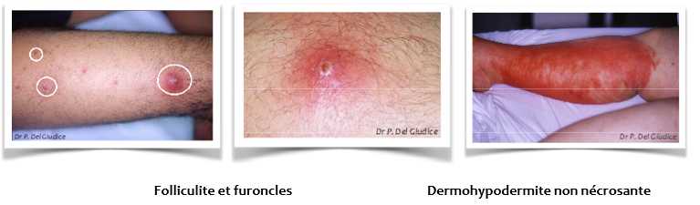 Les infections suppuratives