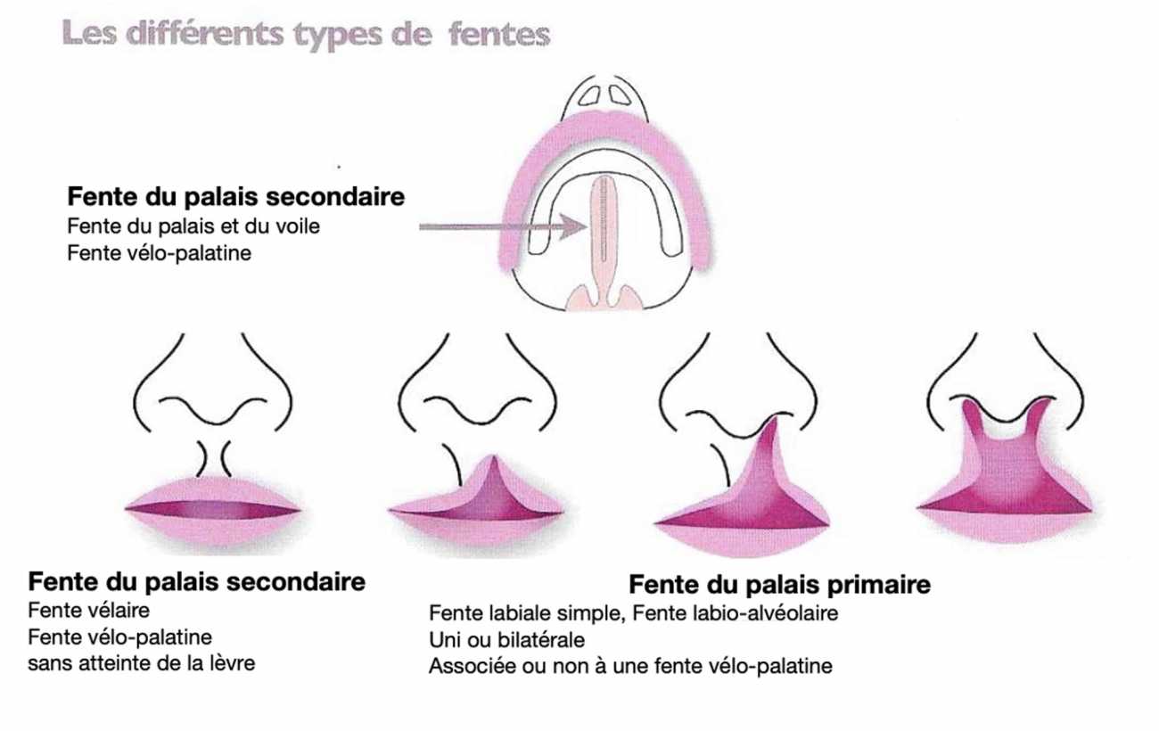 Les différents types de fentes
