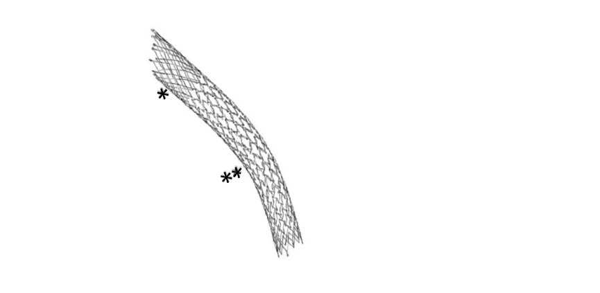 Exemple d’un stent veineux spécifique au syndrome de Cockett : stent Optimed Sinus Obliquus