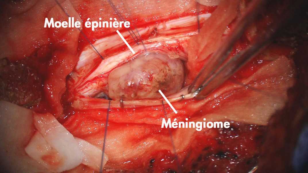 Chirurgie d'un méningiome