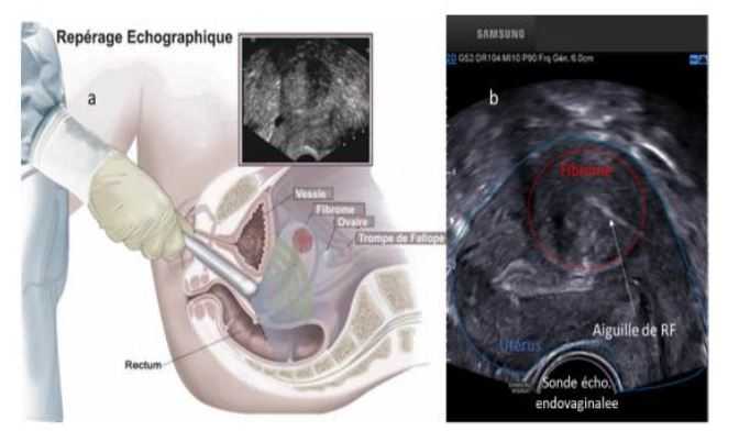Myomectomie par radio fréquence