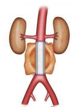 Figure 3 : Pontage aorto-aortique