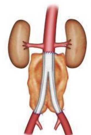 Figure 4 : Pontage aorto bi iliaque