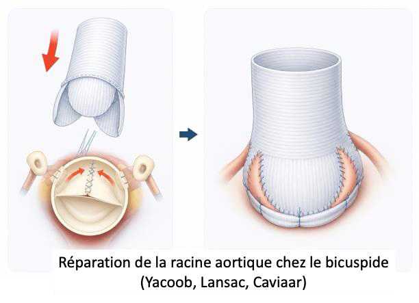 Schéma explicatif de la réparation de la racine aortique chez le bicuspide
