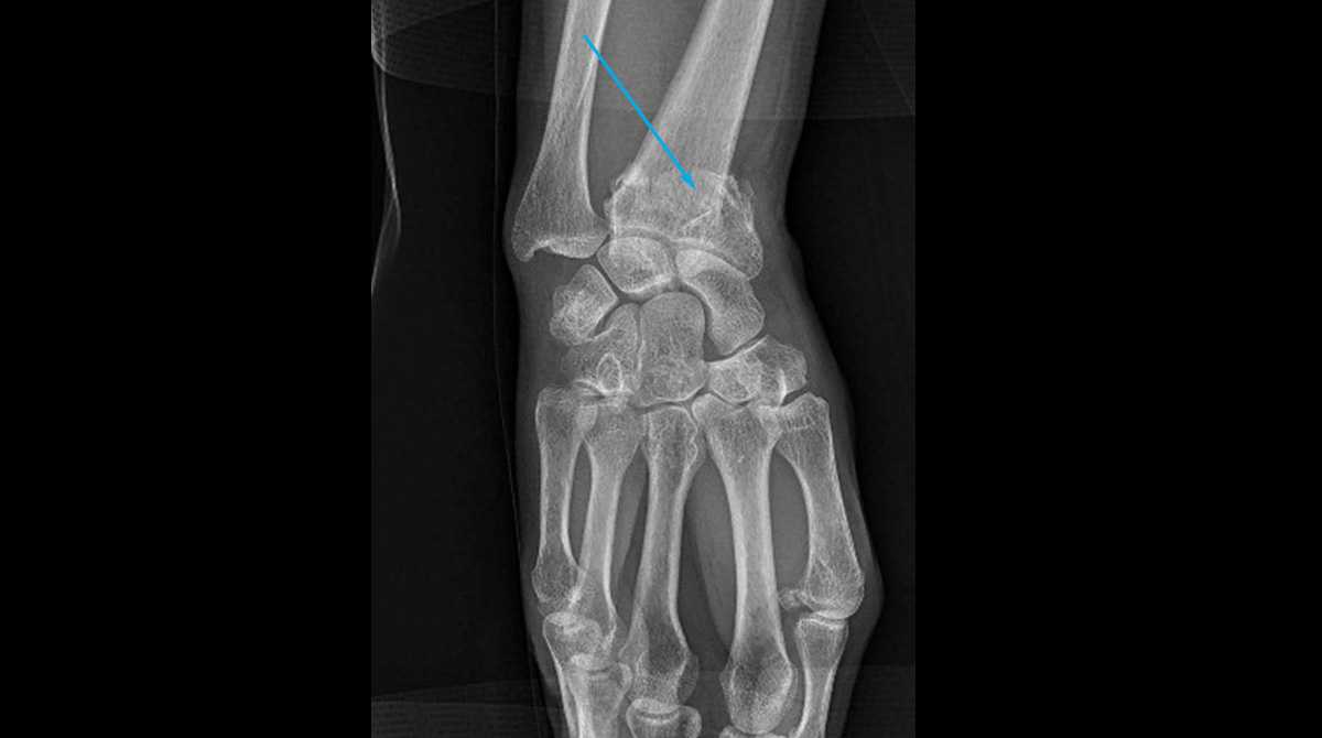 Fracture du radius distal (fracture du poignet) | Fiche santé HCL