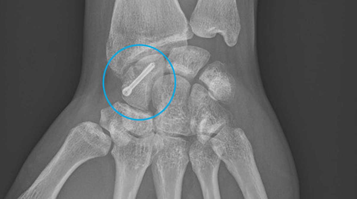 Fracture du scaphoïde | Fiche santé HCL