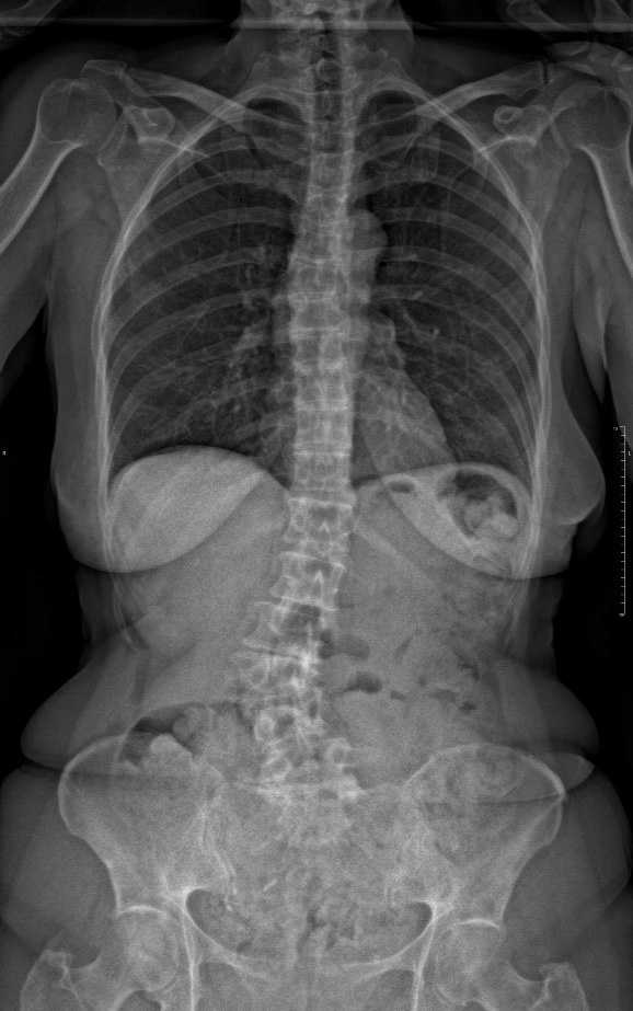 Imagerie d'une scoliose adulte
