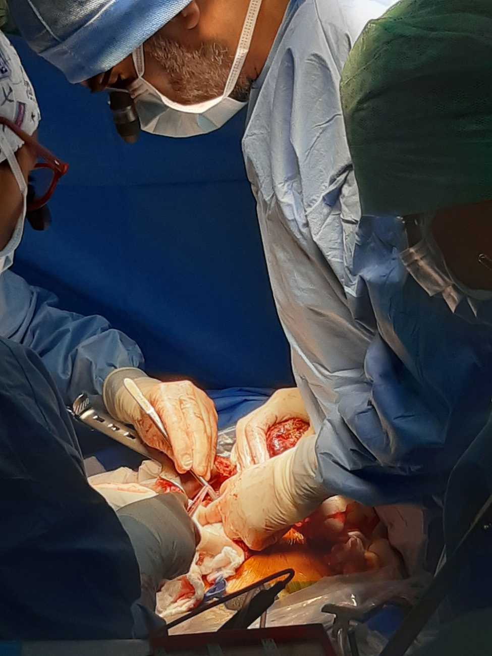L’incision faite, des écarteurs nécessaires pour retirer l’organe le plus volumineux du corps humain, sont posés et délicatement, les chirurgiens accèdent au foie.