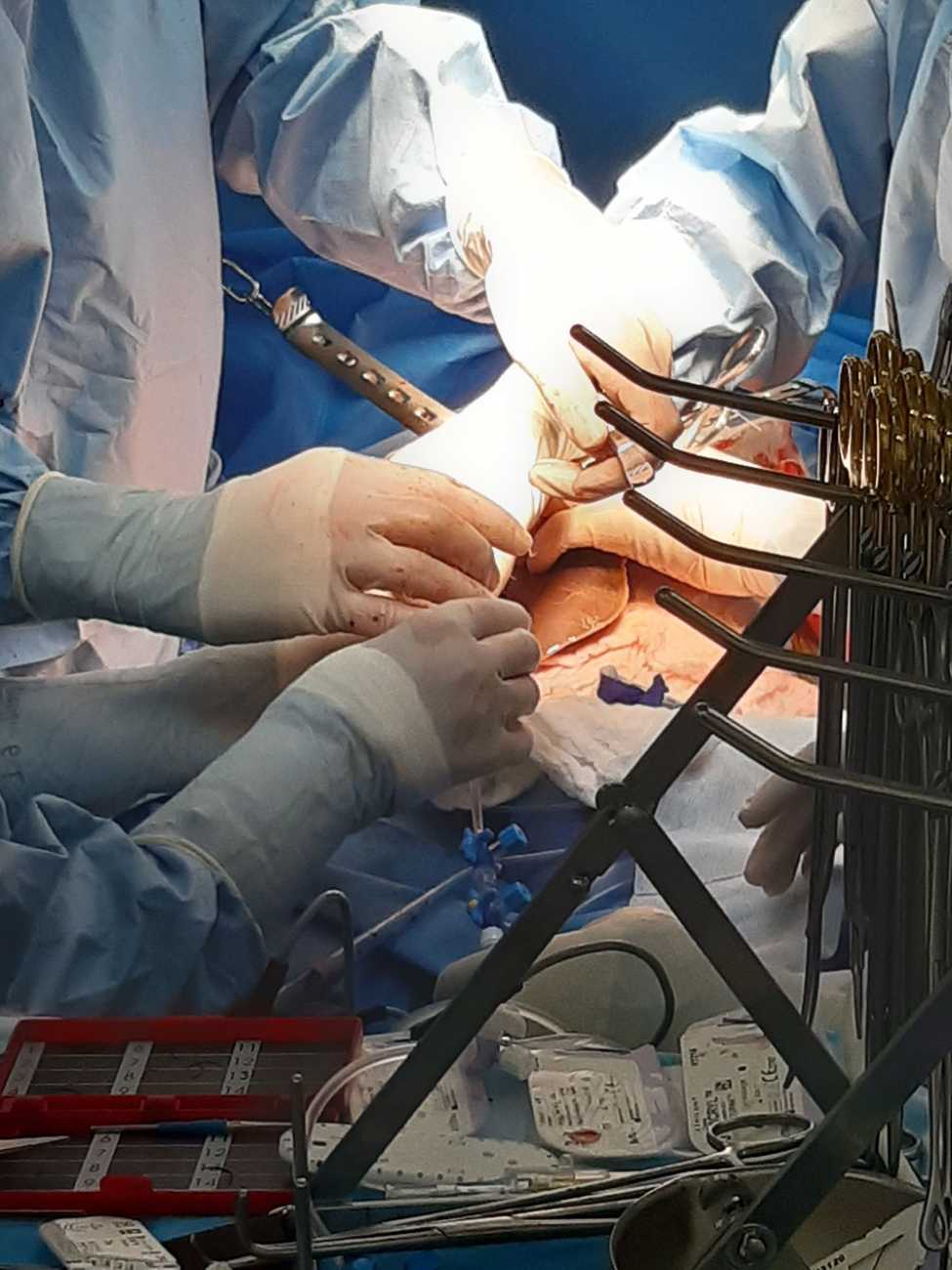 Le greffon est placé dans la cavité abdominale pour que les chirurgiens réalisent les anastomoses qui permettront de reconnecter les vaisseaux et la voie biliaire du greffon sur ceux du receveur, en commençant par la veine cave puis la veine porte