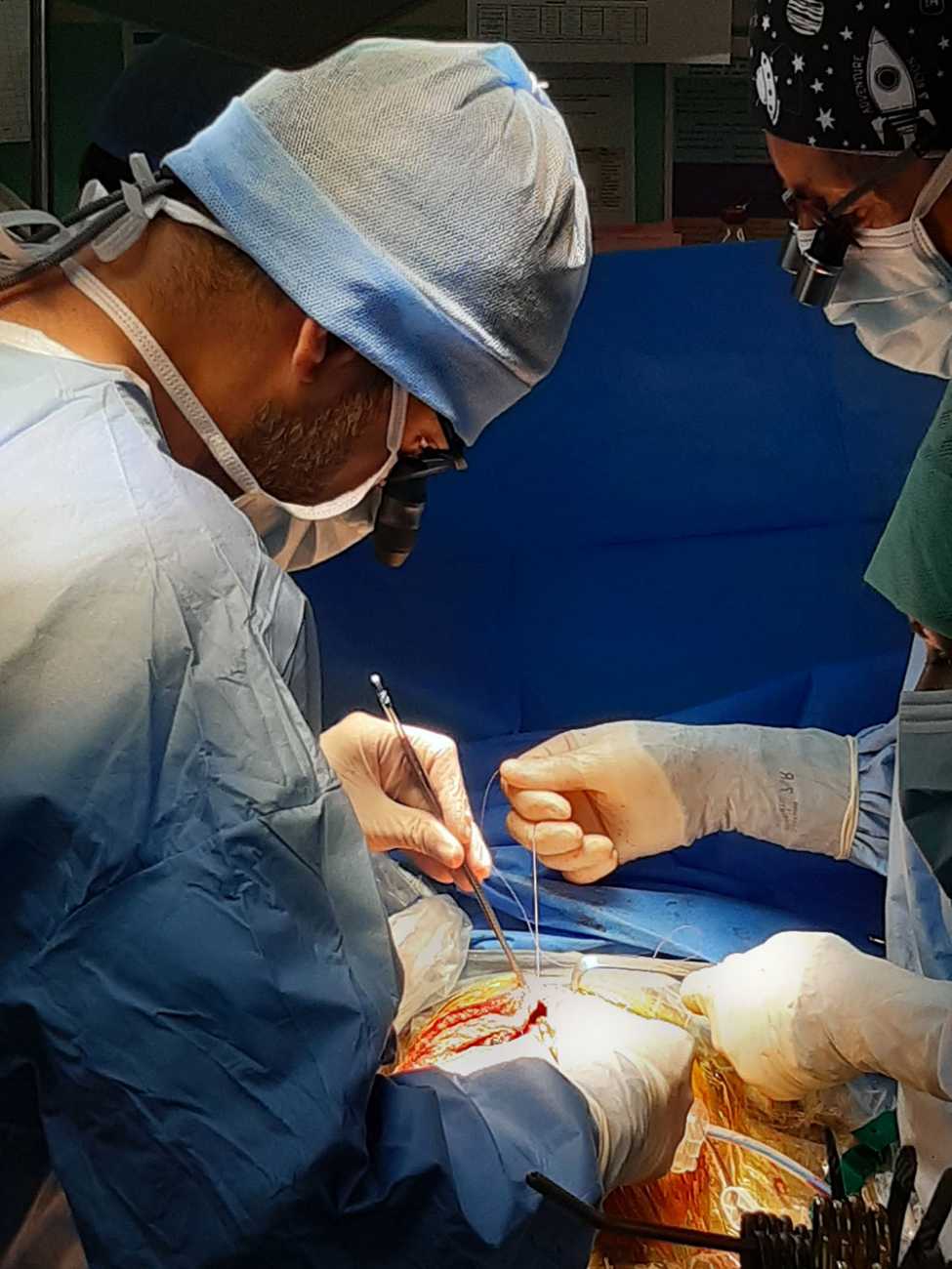 Les chirurgiens referme la paroi abdominale en prenant soin de recoudre tous les plans musculaires un par un, la greffe est terminée