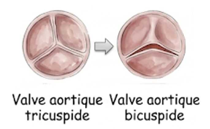 Schéma explicatif différence entre une valve aortique tricuspide et une une valve aortiquebicuspide