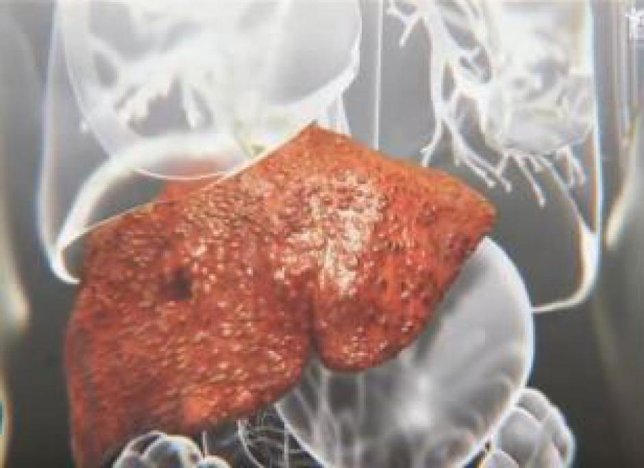 Nash-maladie du foie gras- maladie du soda